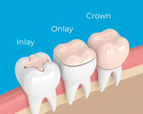 Diagram comparing dental inlay, onlay, and crown restorations on three molars, showing varying degrees of tooth coverage