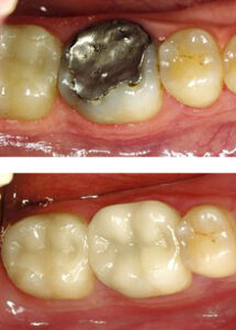 Two-part image showing a molar with a large silver amalgam filling in the top photo and natural-looking tooth-colored restorations in the same position in the bottom photo